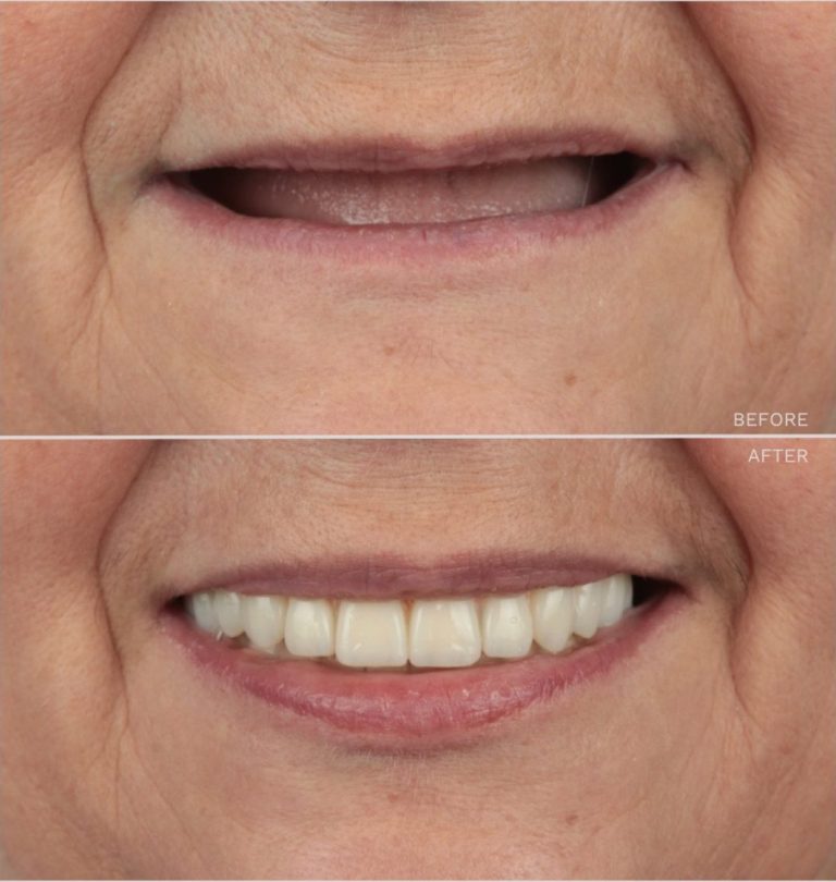 All on 6 - Before and after